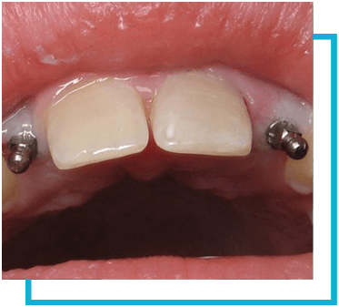 Mini-Dental-Implants